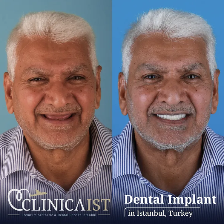 dental-implants-turkey