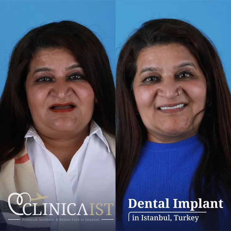 dental-implants-turkey