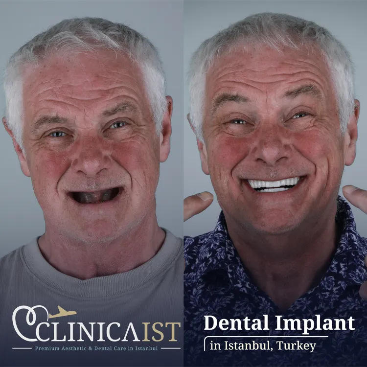 dental-implants-turkey