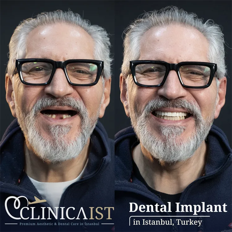 dental-implants-turkey