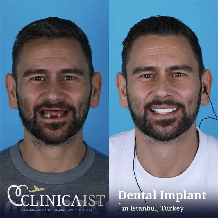 dental-implants-turkey