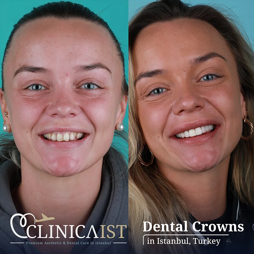 dental-crown-istanbul-turkey