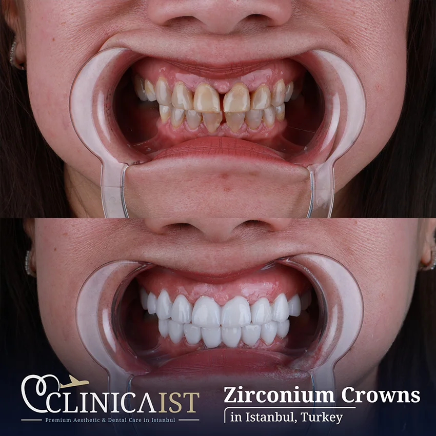 dental-crown-turkey