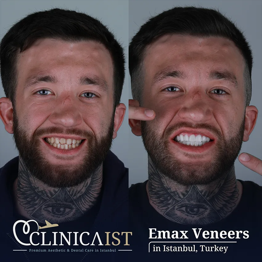 dental-veneers-istanbul