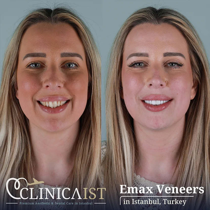 dental-veneers-turkey