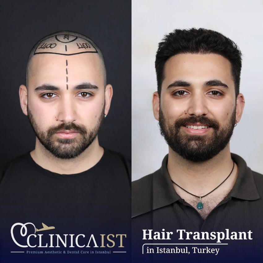 dhi-before-after
