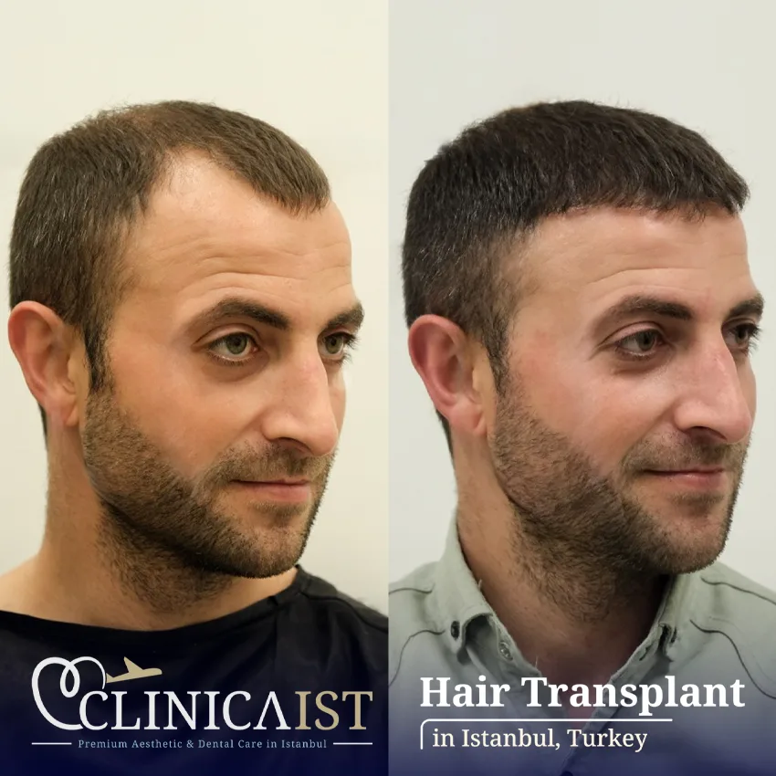 dhi-hair-transplant-before-after