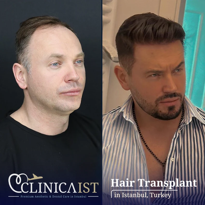 dhi-hair-transplant-before-after