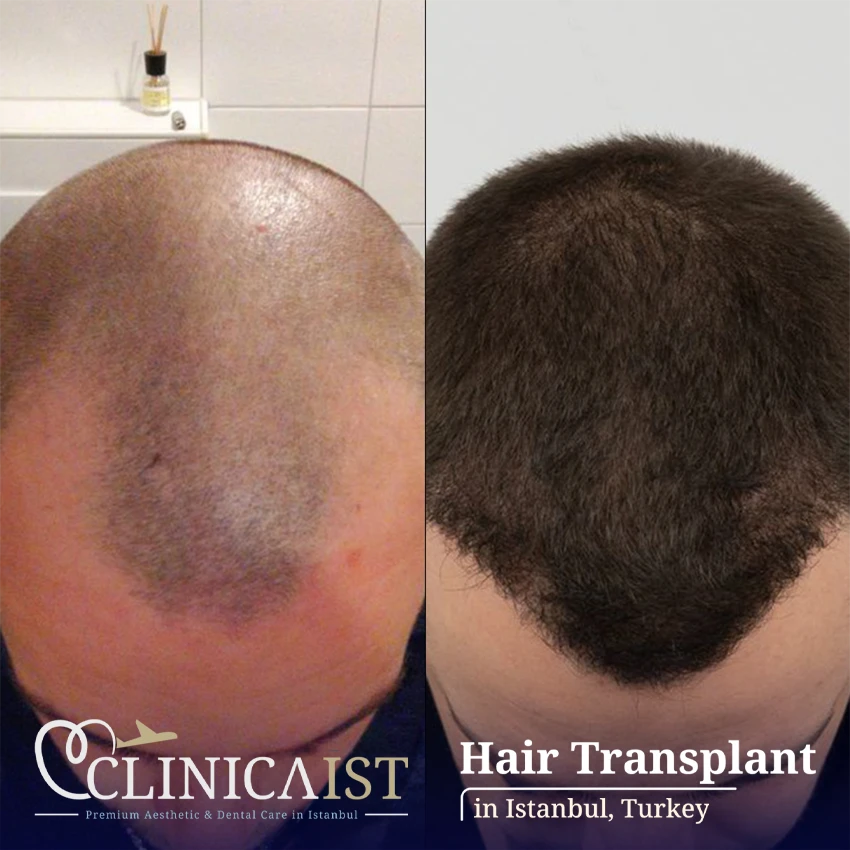 dhi-hair-transplant-before-after