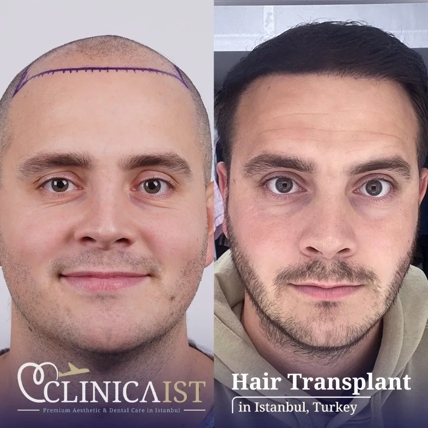 dhi-hair-transplant-before-after