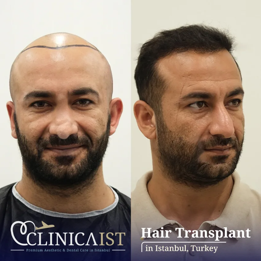 dhi-hair-transplant-before-after