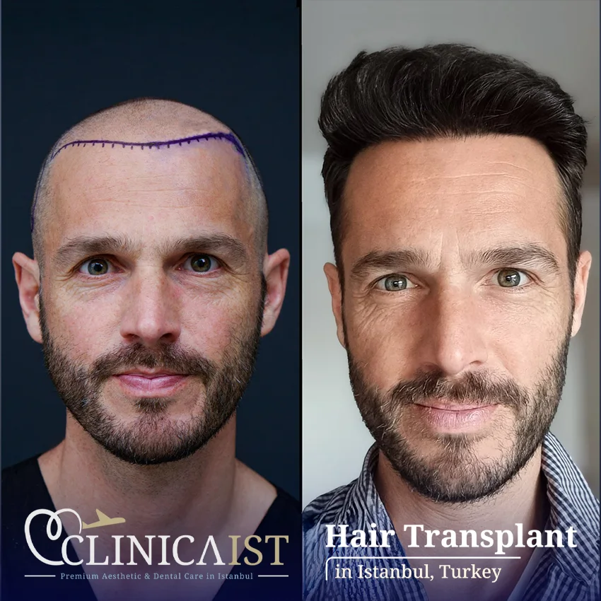 dhi-hair-transplant-result