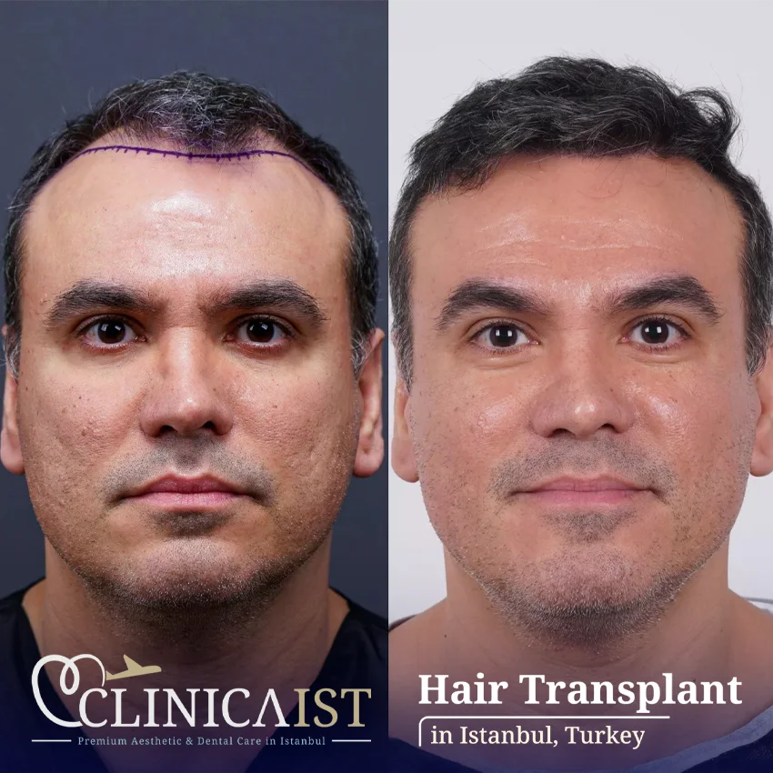 dhi-hair-transplant-turkey-before-after