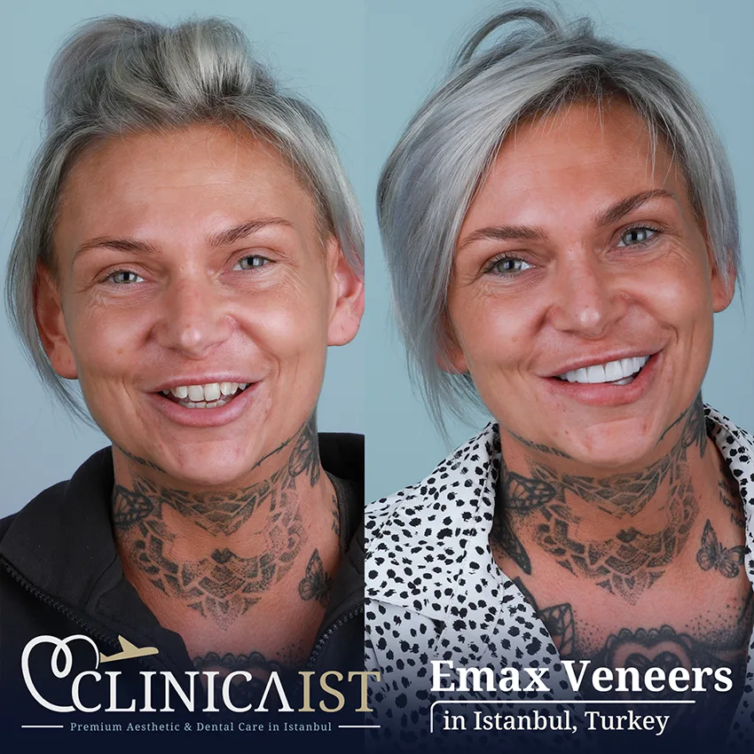 emax-dental-veneers-istanbul
