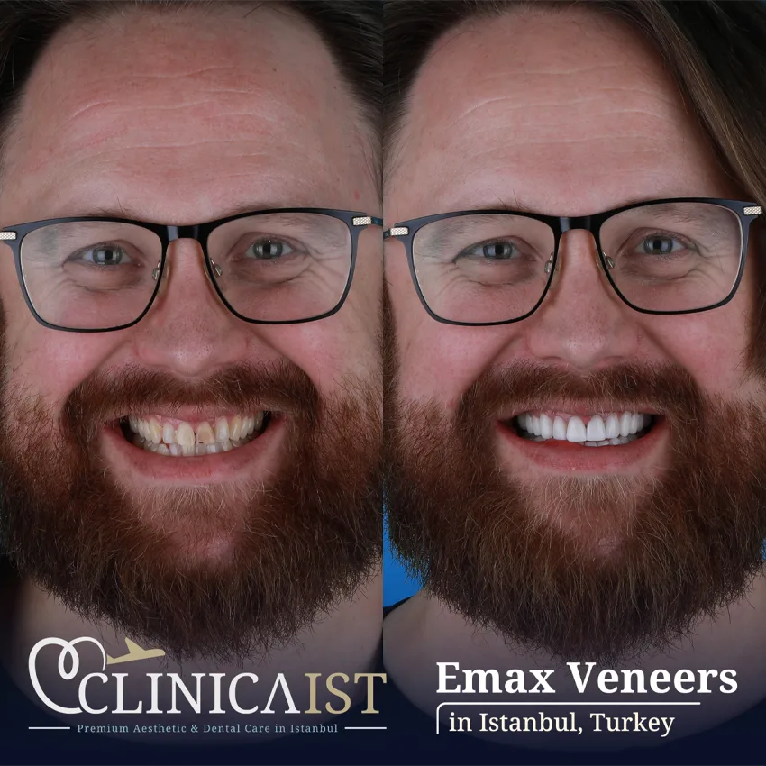 veneers-istanbul