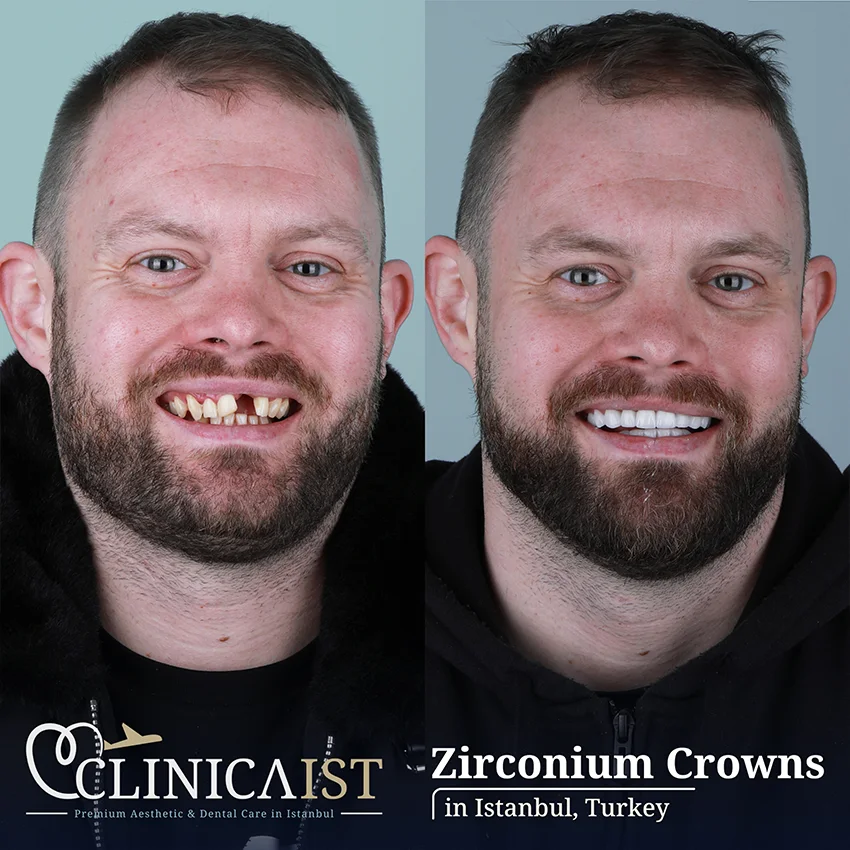 zirconium-crown-istanbul