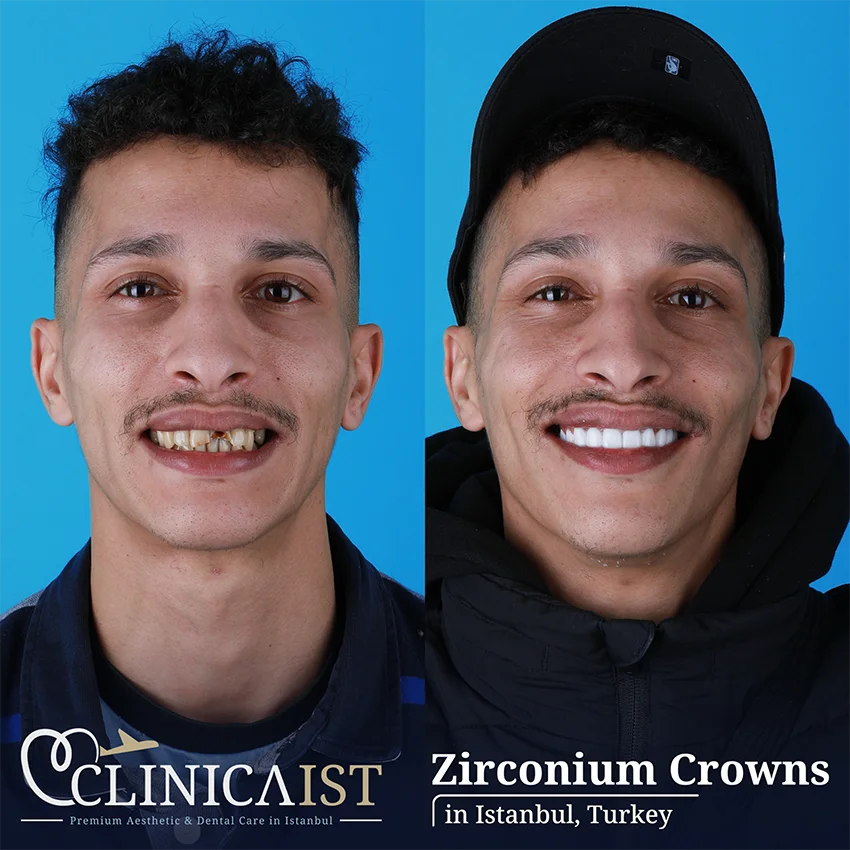zirconium-crown-turkey
