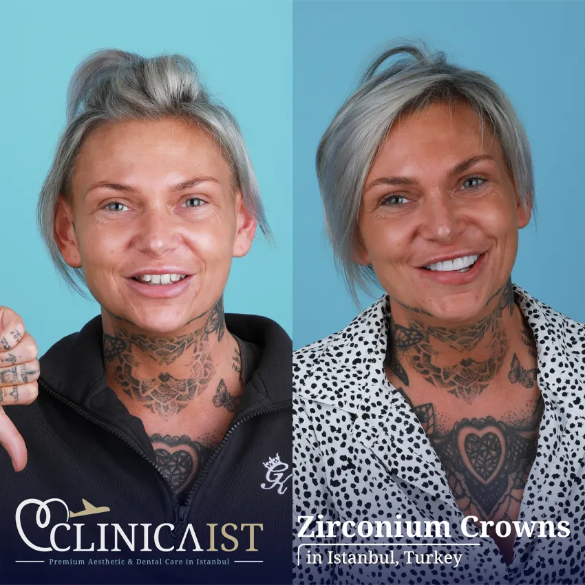 zirconium-crown