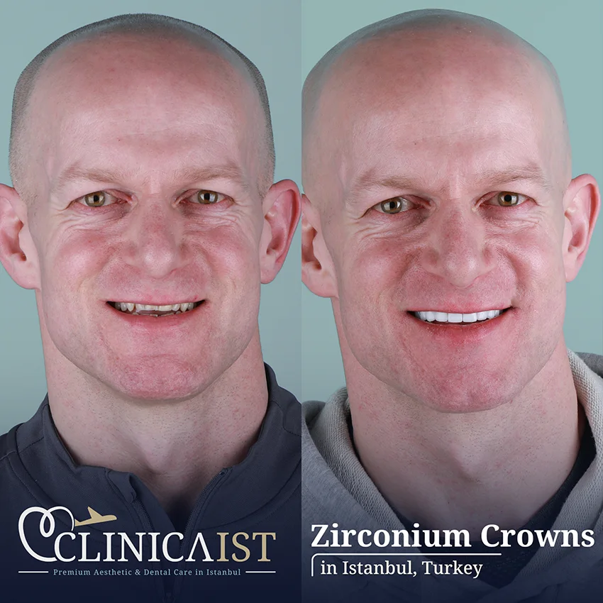 zirconium-crowns-istanbul
