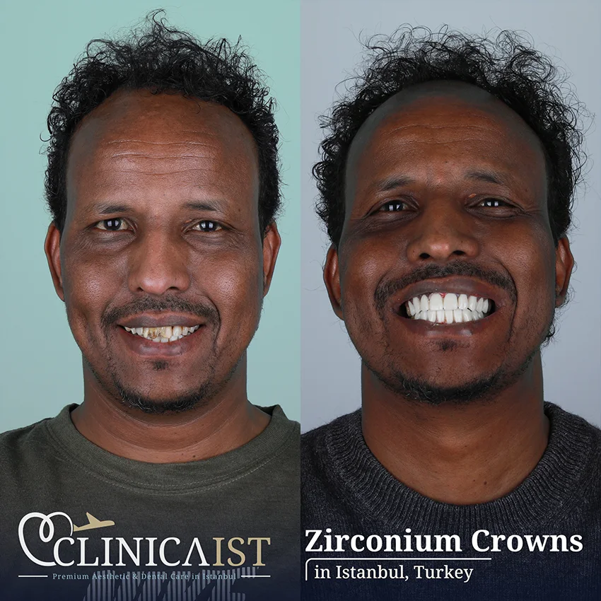 zirconium-crowns-turkey