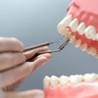Dental Crowns in Turkey